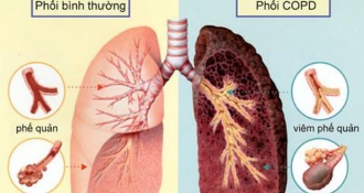 Bệnh COPD là gì? Có chữa được không? Triệu chứng và cách chẩn đoán chính xác